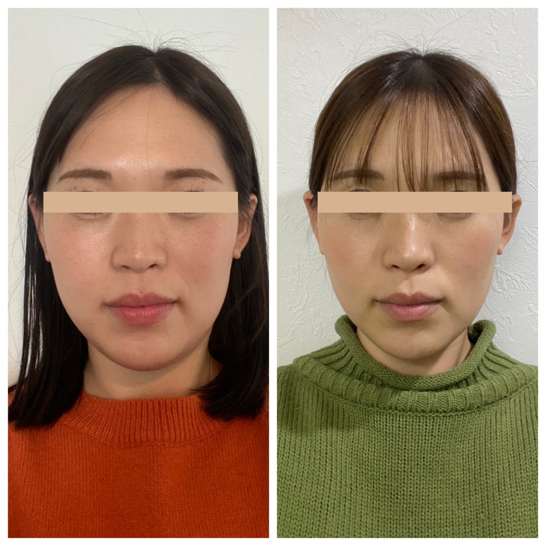 Eimmyの小顔施術前後の比較